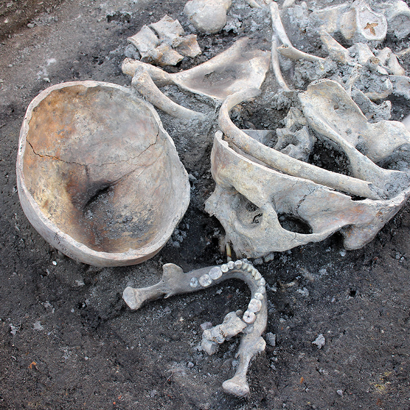 Postmortal geöffneter Schädel mit Hiebverletzung